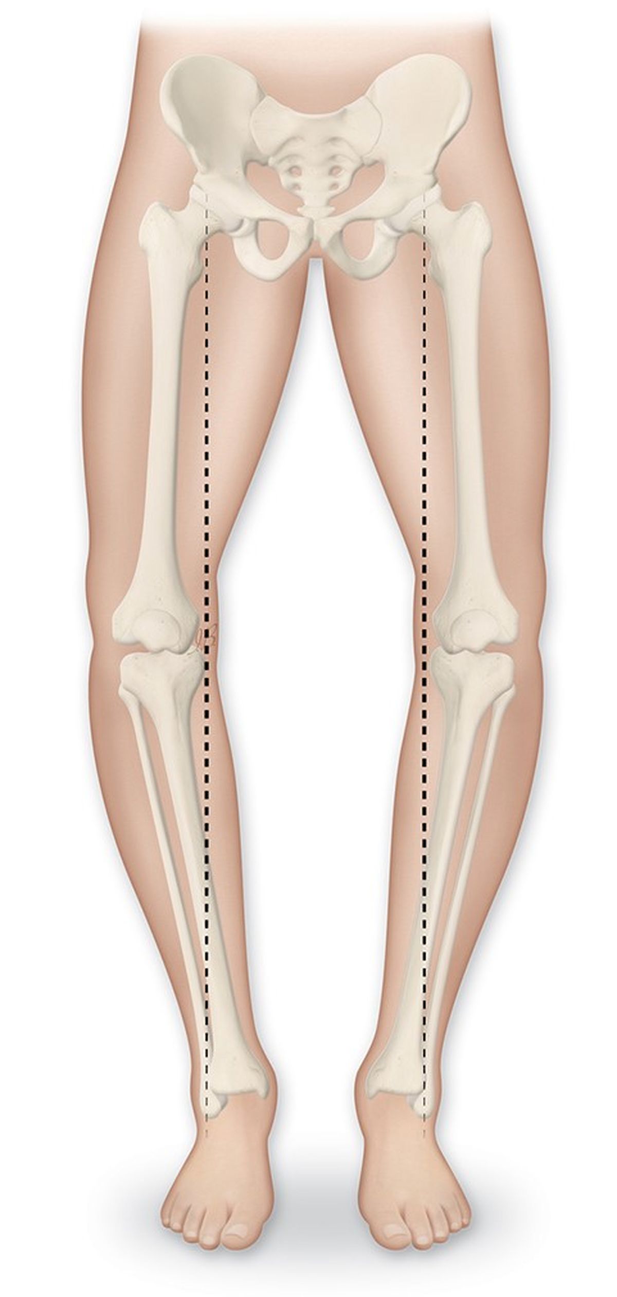 درمان پای پرانتزی با طب سوزنی ممکن است ؟