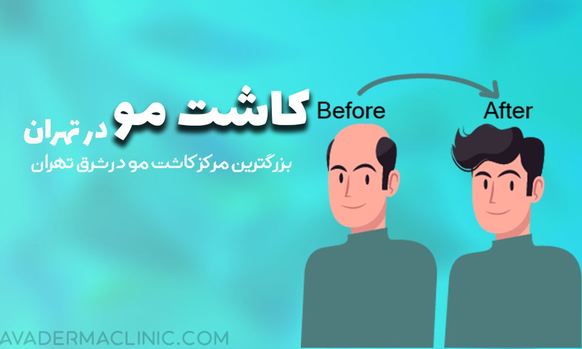 بهترین کلینیک کاشت مو و ابرو در تهران
